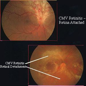 cytomegalovirus retinitis